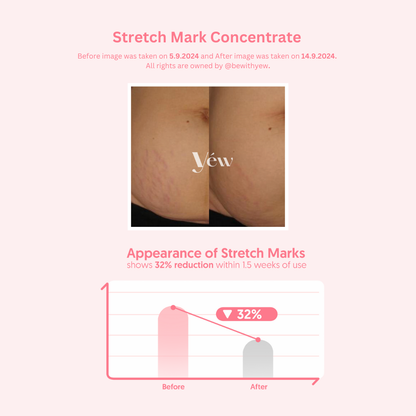 Stretch Mark Concentrate