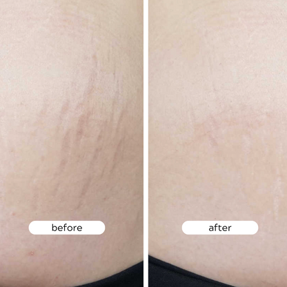 Stretch Mark Concentrate